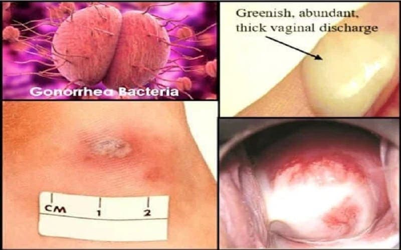dấu hiệu bệnh lậu ở nữ giai đoạn đầu