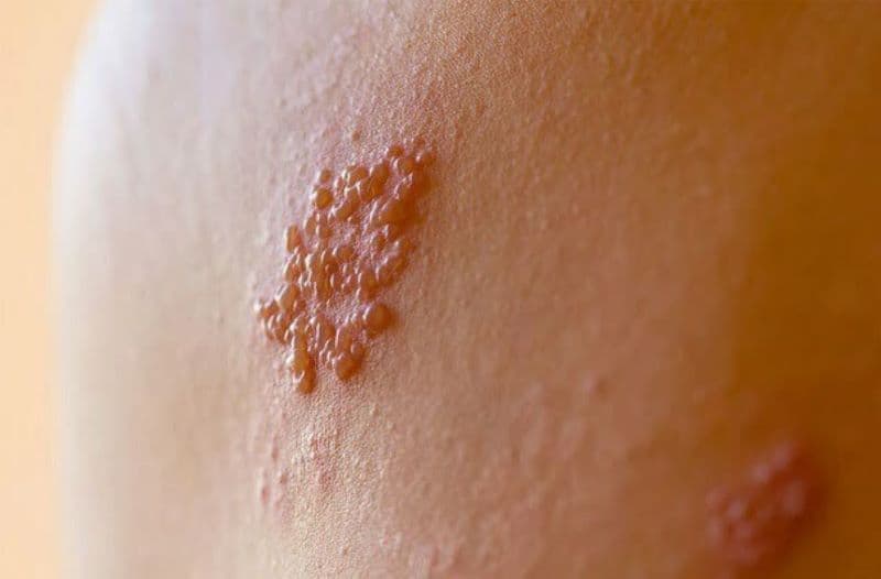 mụn rộp sinh dục nam có nguy hiểm không