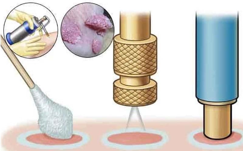 bệnh sùi mào gà có chữa dứt điểm được không