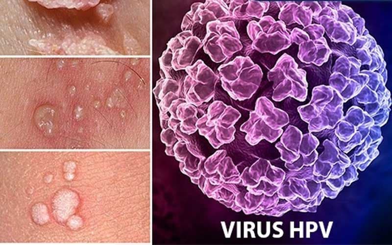 bệnh sùi mào gà có chữa dứt điểm được không