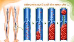 Biến chứng huyết khối tĩnh mạch sâu là gì, có nguy hiểm không?