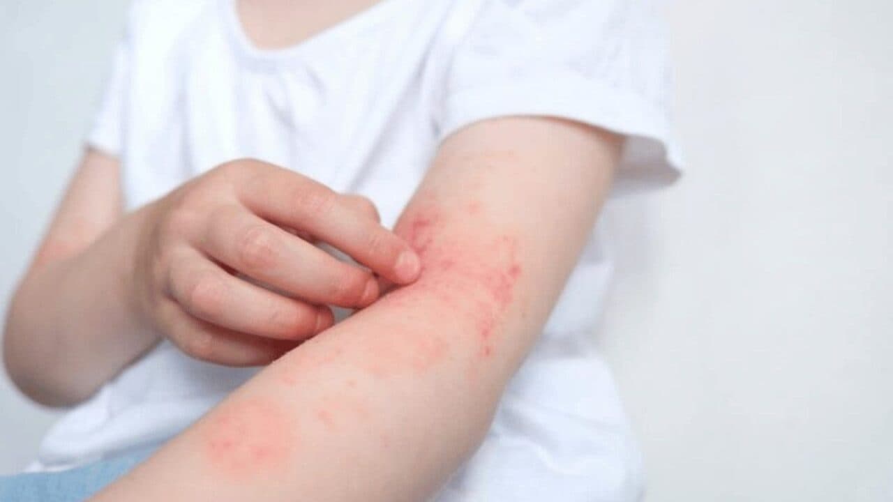 dấu hiệu bị sán chó mèo ở người
