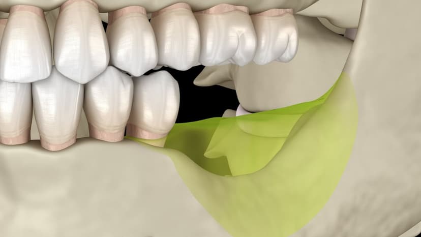 Dấu hiệu và cách khắc phục tiêu xương hàm