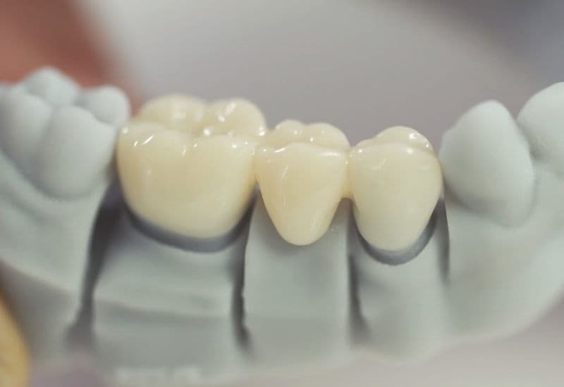 cách vệ sinh cầu răng sứ