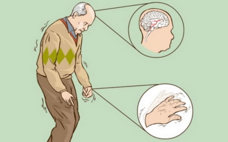 bệnh parkinson có châm cứu được không