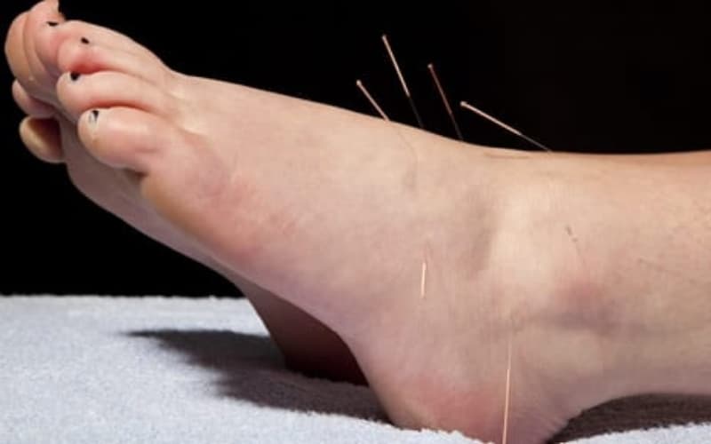 gai gót chân có châm cứu được không