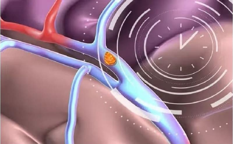 chỉ định tiêu sợi huyết trong nhồi máu cơ tim