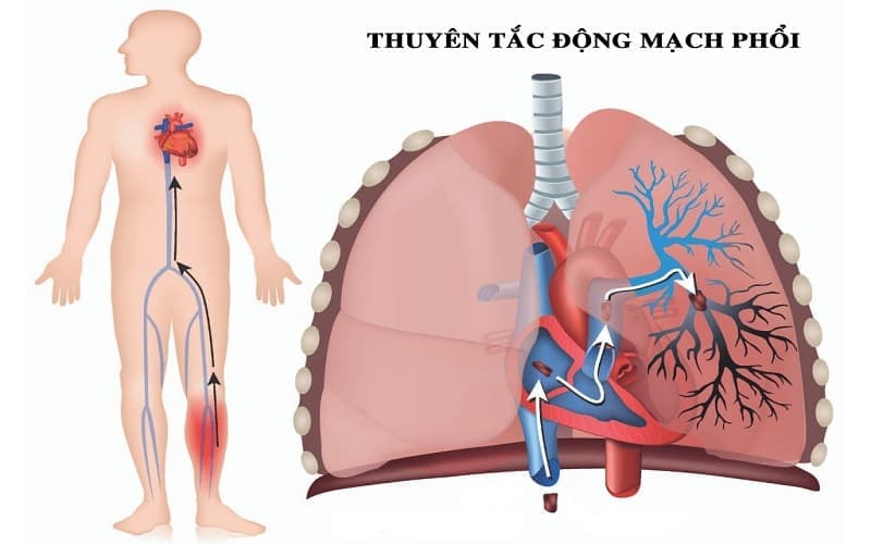 tiêu sợi huyết trong thuyên tắc phổi