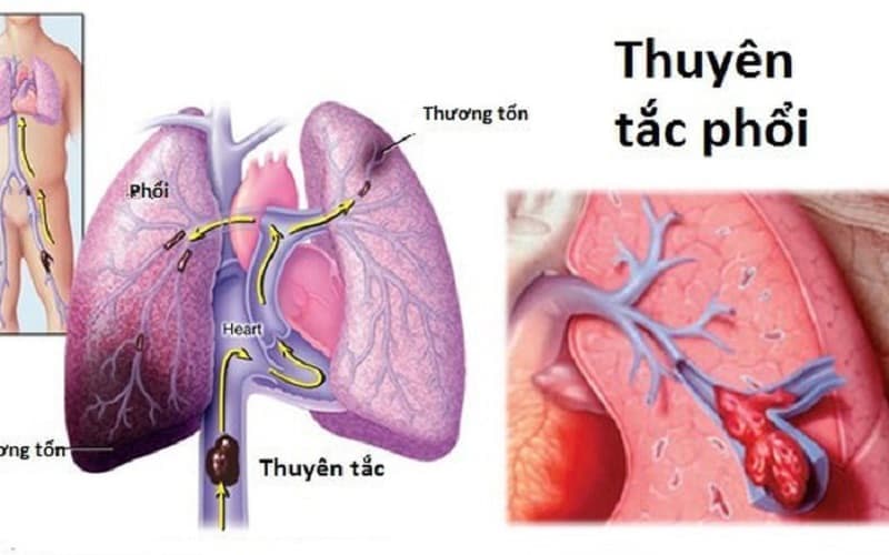 tiêu sợi huyết trong thuyên tắc phổi