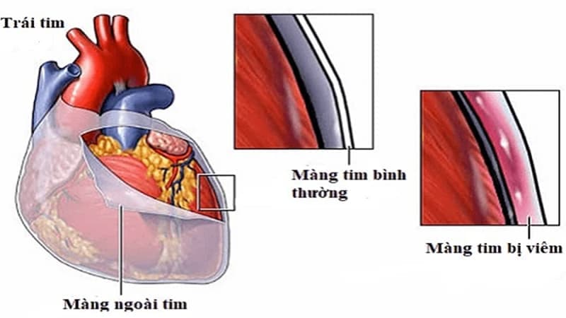 chỉ định tiêu sợi huyết trong nhồi máu cơ tim