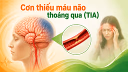 Cơn thiếu máu não thoáng qua có nguy hiểm không?