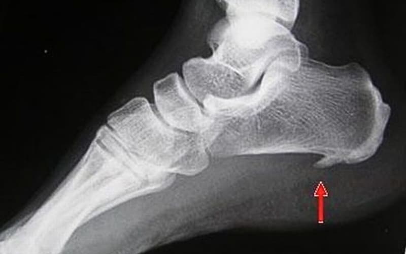gai gót chân có châm cứu được không