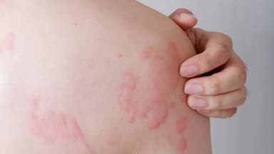 Cách giảm ngứa do dị ứng
