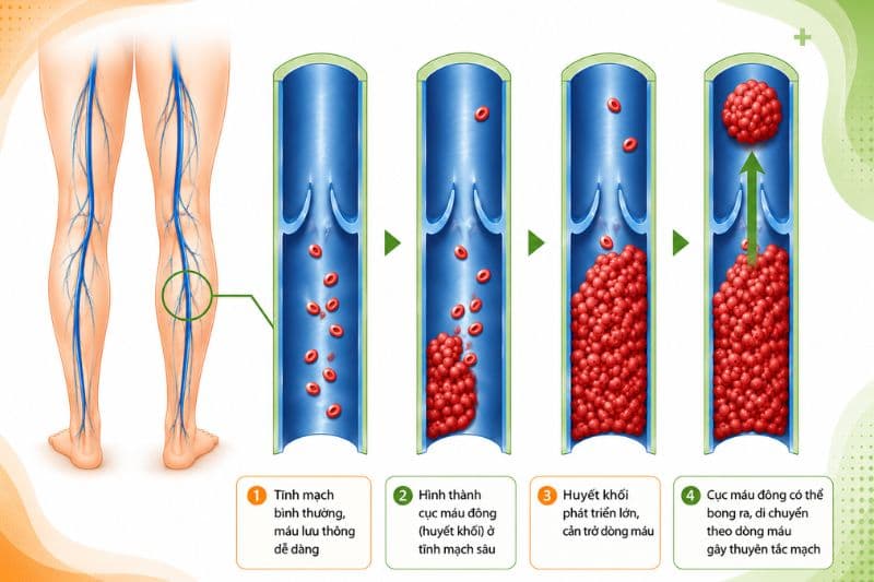 biến chứng huyết khối tĩnh mạch sâu