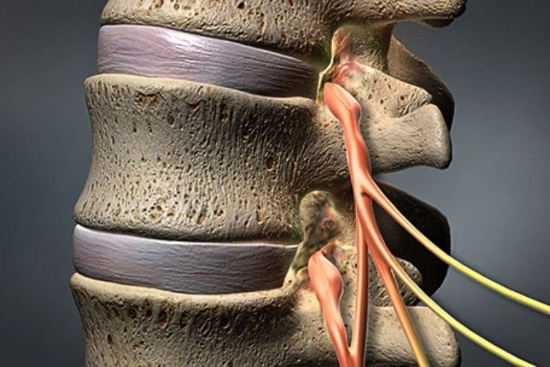 thoái hóa cột sống thần kinh