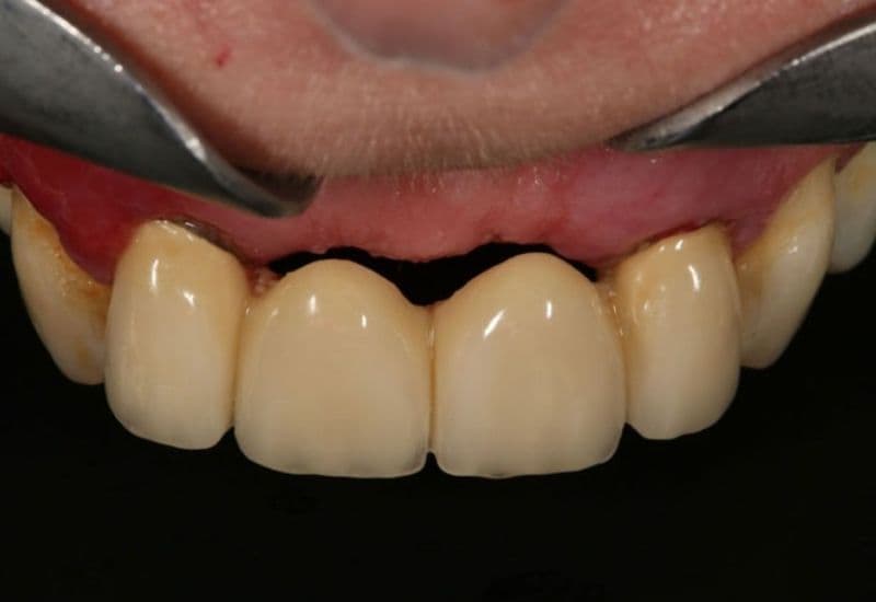 làm cầu răng có bị tiêu xương không