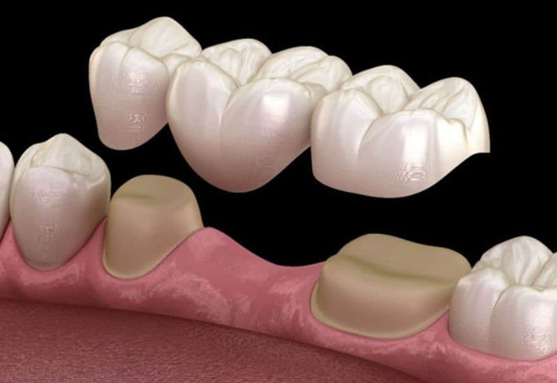 mất chân răng có trồng răng sứ được không
