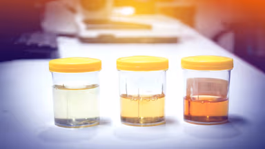 Màu nước tiểu suy thận có gì đặc biệt?