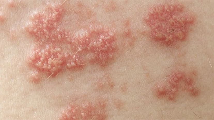 Bị mụn rộp sinh dục bao lâu thì khỏi?