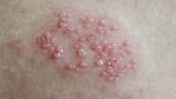 Mụn rộp sinh dục bao lâu thì phát bệnh?