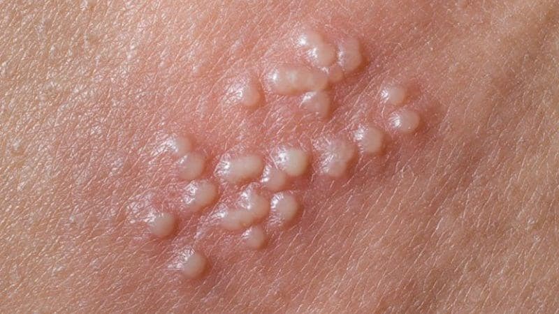 mụn rộp sinh dục trong miệng