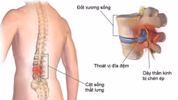 Nguyên nhân gây thoát vị đĩa đệm cột sống