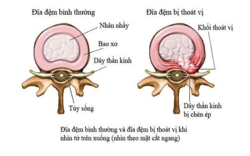 nguyên nhân gây thoát vị đĩa đệm cột sống