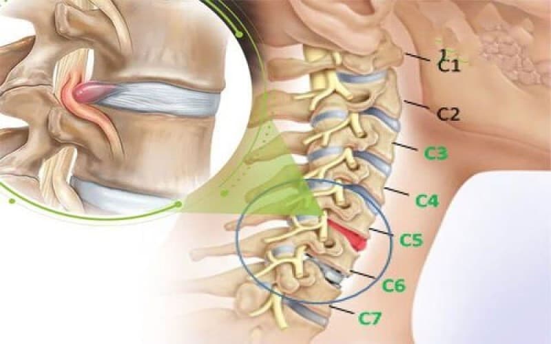 tê yếu chân tay sau khi mổ đốt sống cổ
