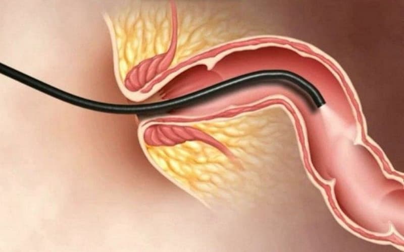 khi nào cần nội soi tiêu hóa
