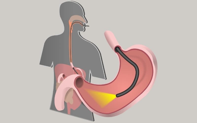 nội soi tiêu hóa gồm những gì
