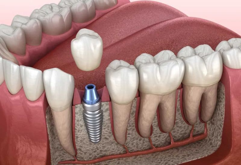 quy trình trồng răng implant chuẩn y khoa