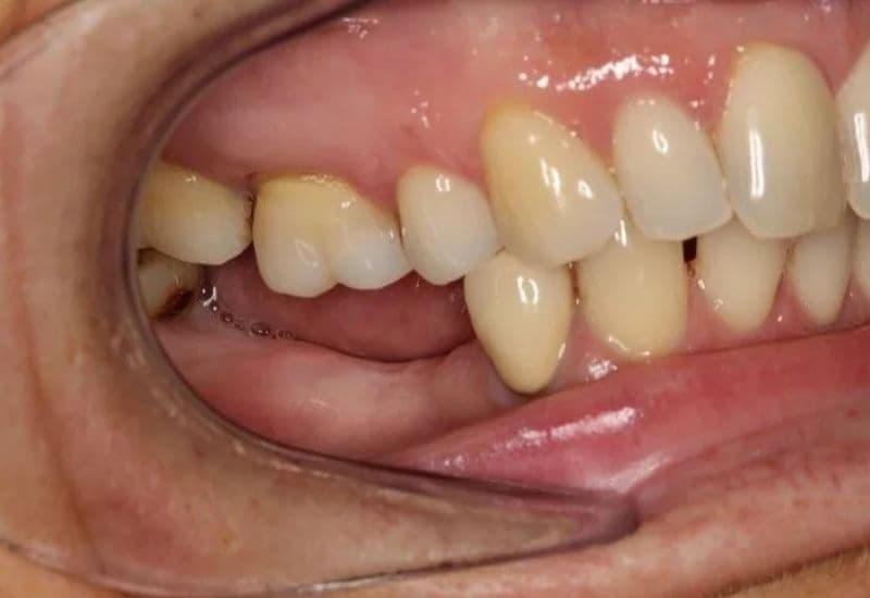 răng bị tiêu xương có phục hồi được không