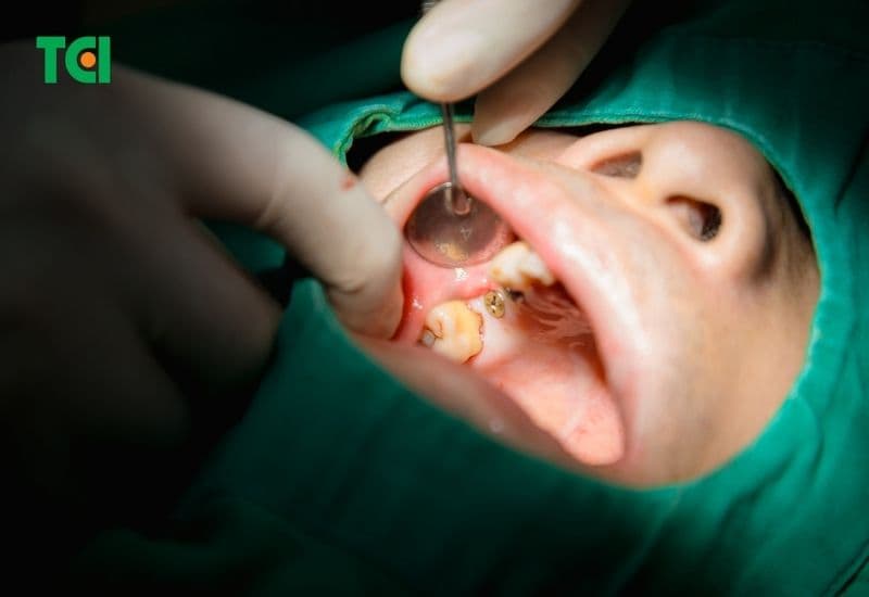 răng bị tiêu xương có phục hồi được không