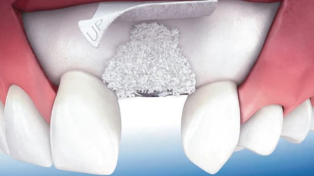 Răng bị tiêu xương có phục hồi được không?