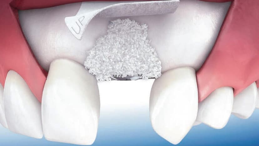 Răng bị tiêu xương có phục hồi được không?