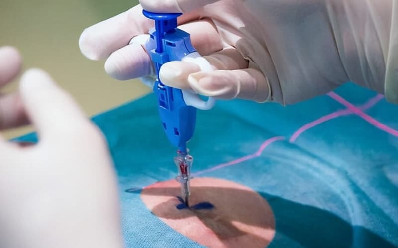 tầm soát ung thư dạ dày bằng cách nào?