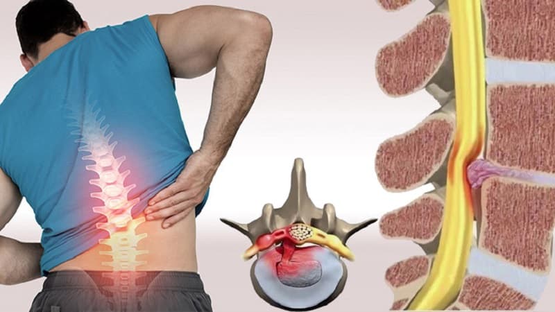 thoát vị đĩa đệm có làm nặng được không