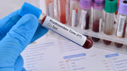 Thời gian prothrombin là gì? Vì sao cần trong tầm soát đột quỵ?