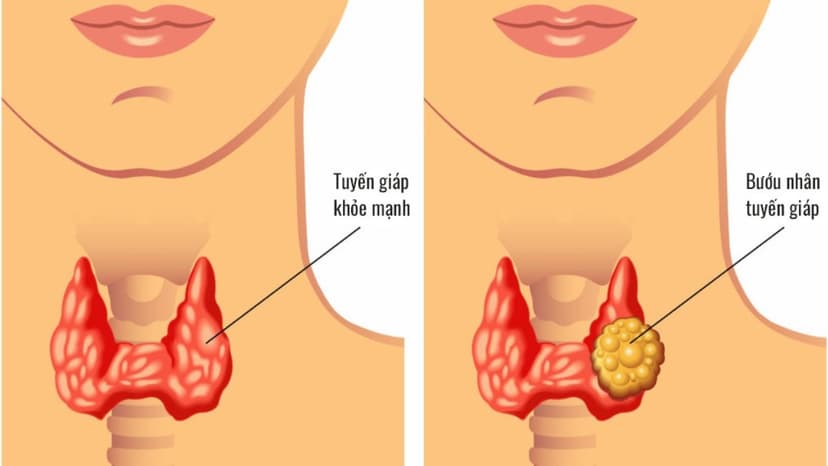 Trẻ em bị nhân tuyến giáp có nguy hiểm không?