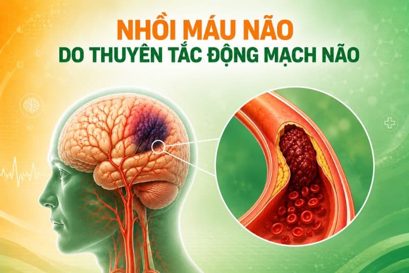 nhồi máu não do thuyên tắc động mạch não