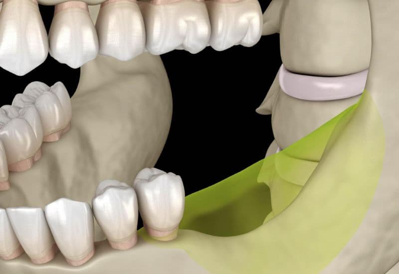 tiêu xương có niềng được không