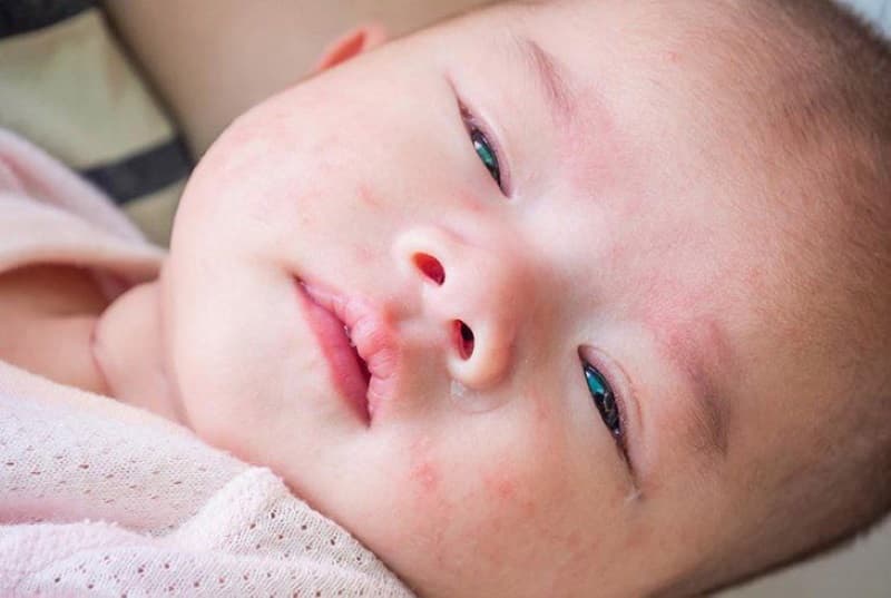 trẻ em bị phát ban nhưng không sốt