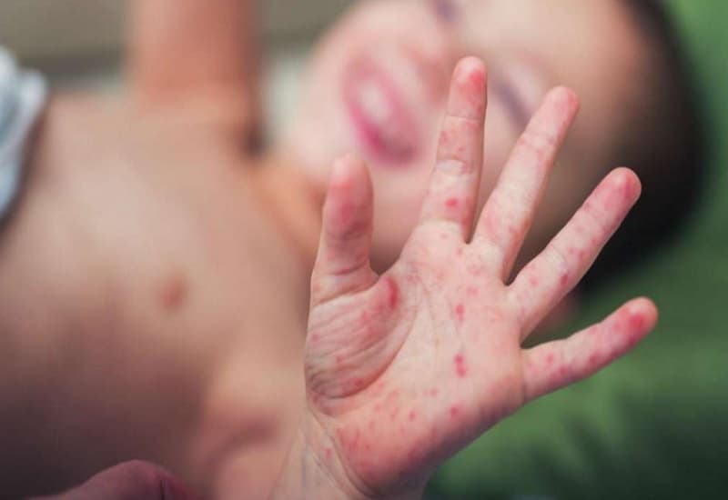 dấu hiệu bị sán chó ở trẻ em