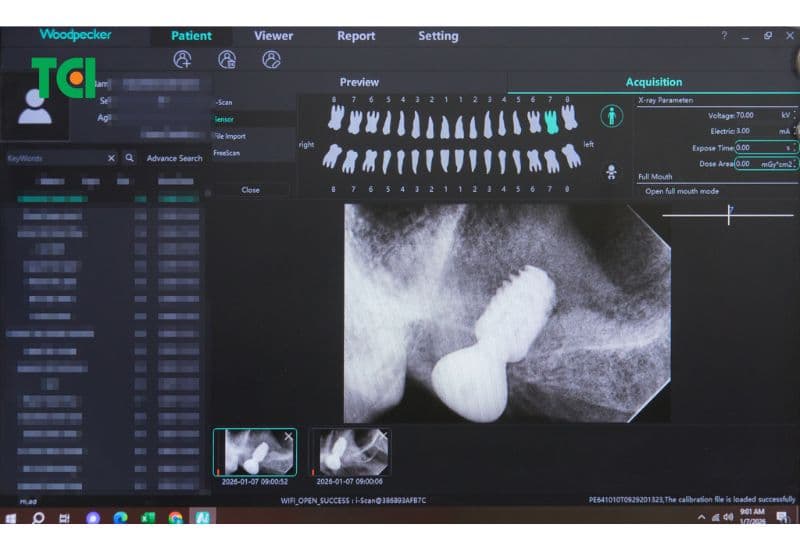 trồng răng implant có ăn được thịt gà không