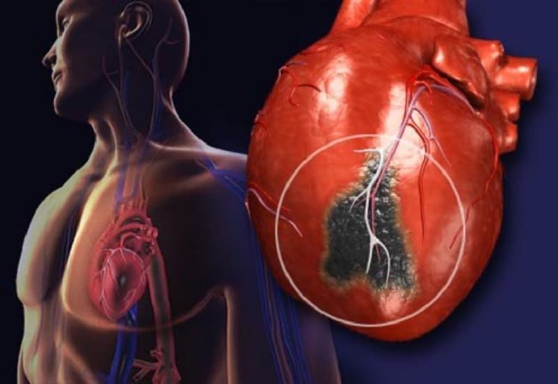 tiêu chuẩn chẩn đoán nhồi máu cơ tim