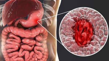 Ung thư dạ dày phát triển trong bao lâu, quá trình tiến triển và cách phát hiện sớm