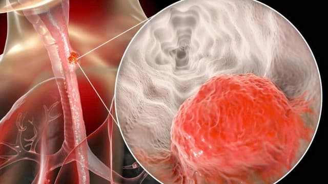 Ung thư thực quản phát triển trong bao lâu, thời gian tiến triển và cách phát hiện sớm