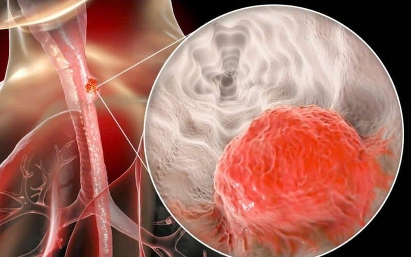 ung thư thực quản phát triển trong bao lâu