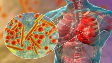Vi khuẩn mycoplasma gây bệnh gì?