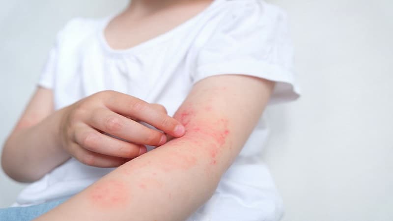 vi khuẩn tụ cầu vàng gây bệnh gì